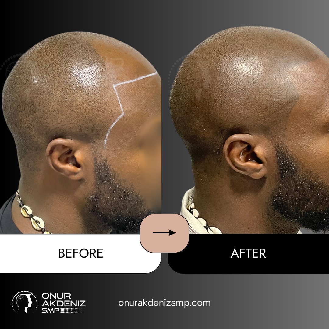 onurakdenizsmp's tweet image. 🖤 From uncertainty to confidence! 💪 This incredible before-and-after showcases the power of Scalp Micropigmentation. Achieve a natural, sharp hairline and develop a new level of self-assurance. I&apos;m proud to create these transformations in Istanbul! 🖌️🌍

#smp #micropigmentation…