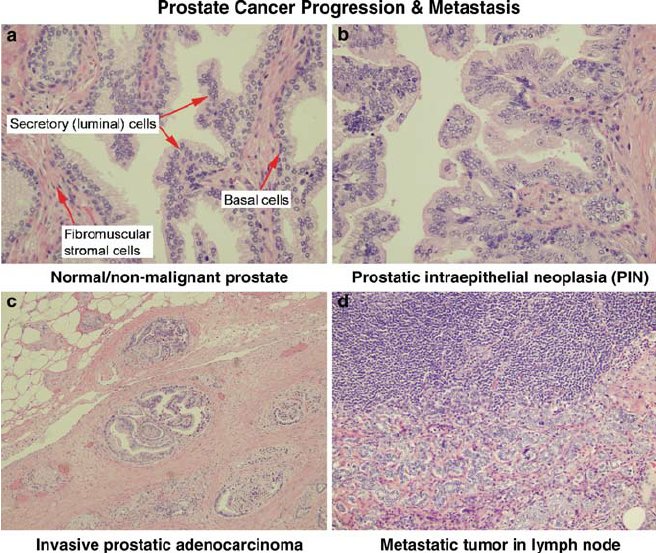 thejourneymate's tweet photo. Compare and Contrast
Histopathology of the Prostate cancer progression ๐ฌ
https://t.co/q0lzZL0yLp
#BasicPath https://t.co/neLcVXUQex