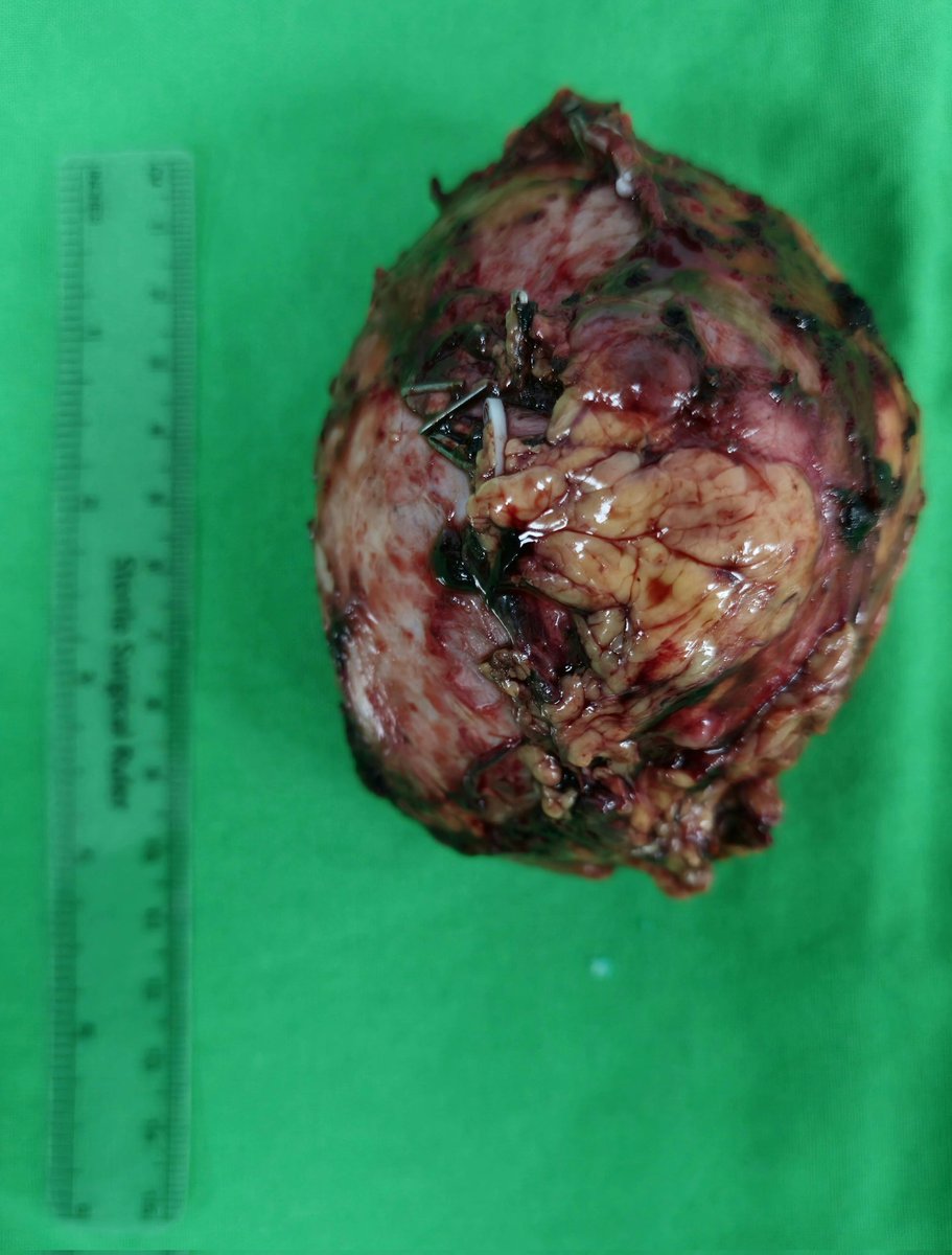The CT scan revealed a large adrenal tumor with significant adhesions, presenting challenges for robotic surgery.  Locating the  adrenal vein is important. Large tumors complicate the procedure due to the displacement of renal vessels, while the hilum remains stationary.