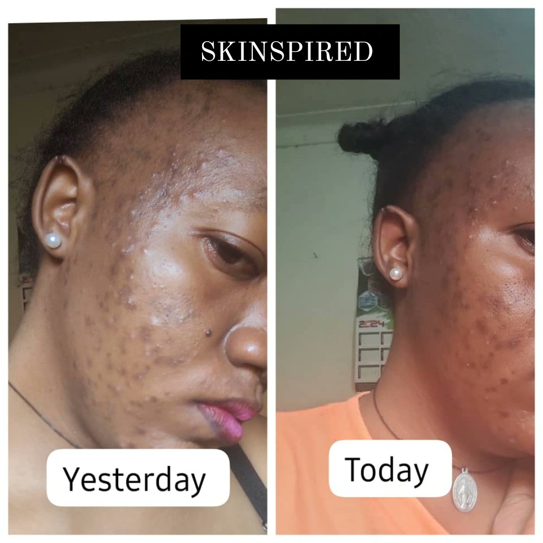 Dashalucky6's tweet image. In just 5days achieve that glowing n acne free skin. Trust us, you won't regret. #SKINSPIRED #skincare #skinroutine