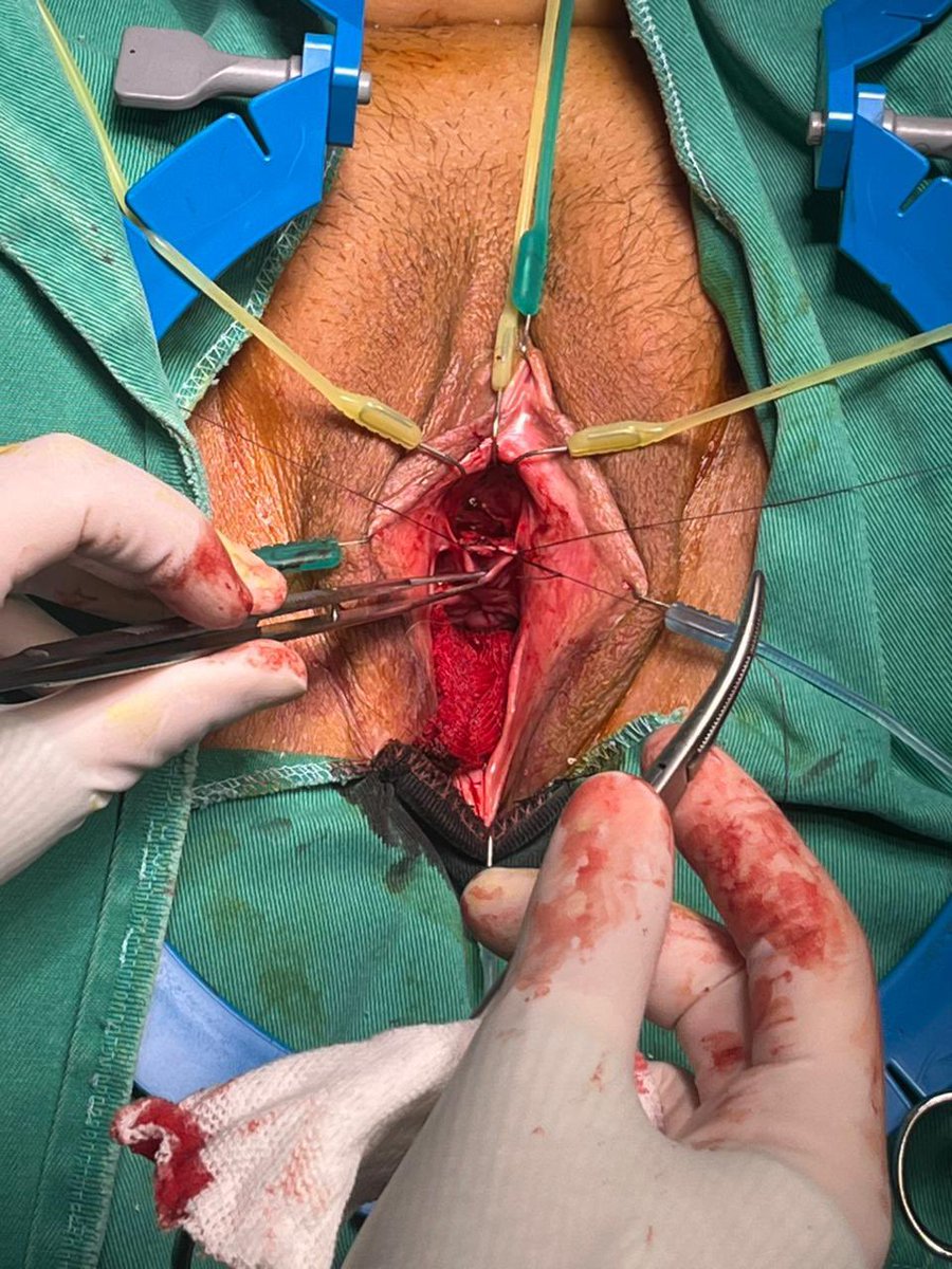 MauroMMeo's tweet photo. 48-year-old female patient with idiopathic urethral stricture. Multiple unsuccessful endoscopic procedures. Urethroplasty with dorsal BMG was performed. Uneventful postoperative course.

#FUS 
#CCU

@SocietyGURS 
@SauUrologia https://t.co/VS50yG4THF
