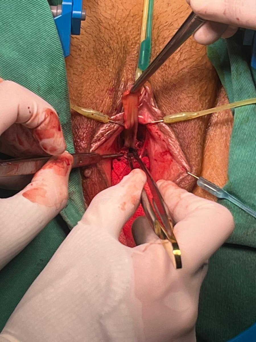 MauroMMeo's tweet photo. 48-year-old female patient with idiopathic urethral stricture. Multiple unsuccessful endoscopic procedures. Urethroplasty with dorsal BMG was performed. Uneventful postoperative course.

#FUS 
#CCU

@SocietyGURS 
@SauUrologia https://t.co/VS50yG4THF