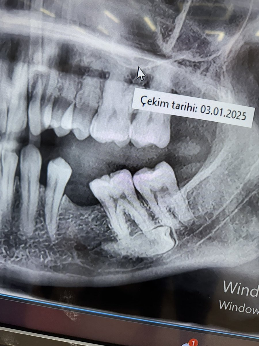 Sörf yapmak

ben: 0
molar diş : 1