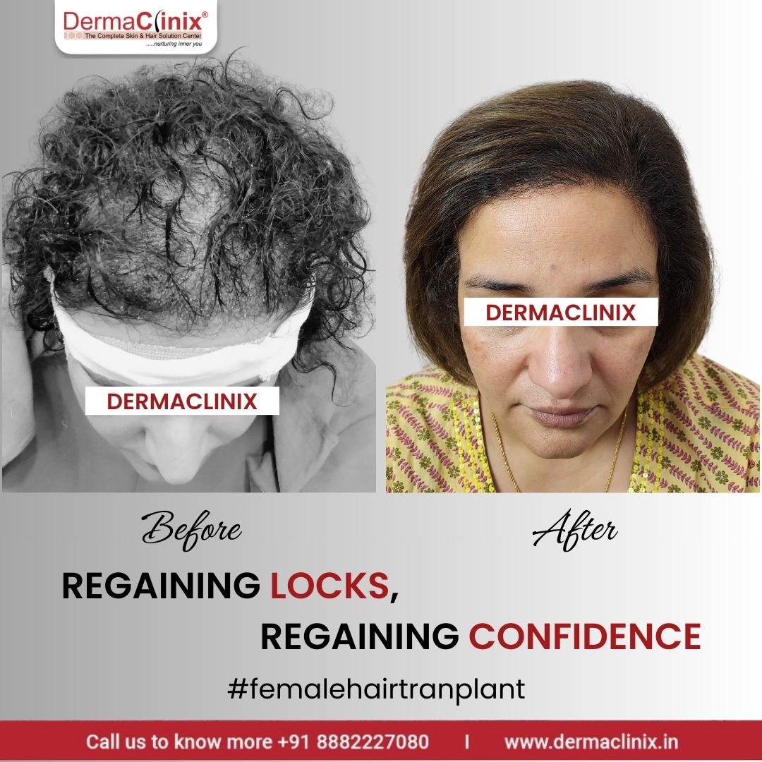 dr_kavish's tweet photo. Women often experience hair loss or thinning across the entire scalp due to various reasons such as postpartum hair loss, aging, hormonal changes, and more.

Call / WhatsApp on +91 8882227080

For more, visit: https://t.co/fE8Nj139nS

#DermaClinix #FUE #FUEHairTransplant https://t.co/Wv4QwCoovW