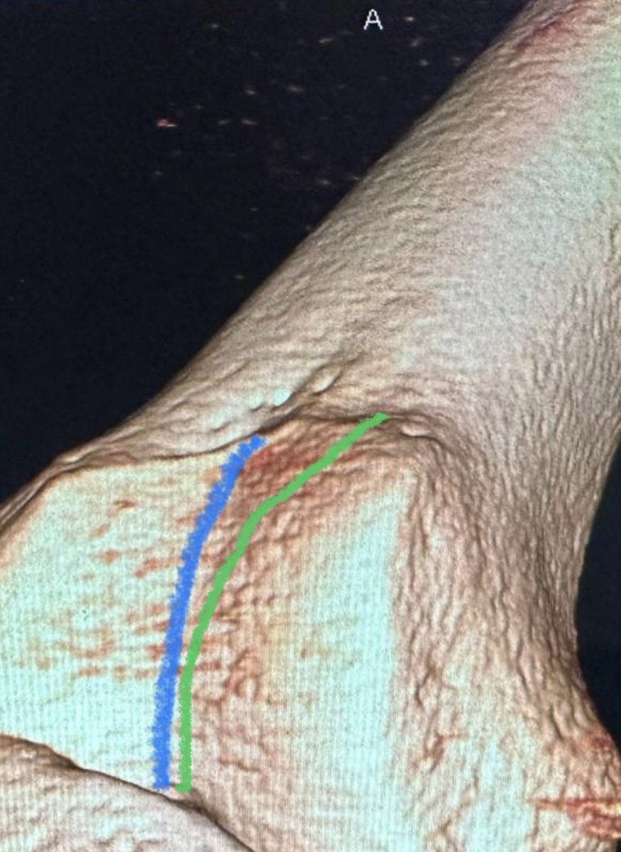 The patella tracking path in this recurrent patella dislocator is the green path! Entrance zone for the patella is between the ends of the medial and lateral ridges. If you take care of patella instability patients, please understand this.