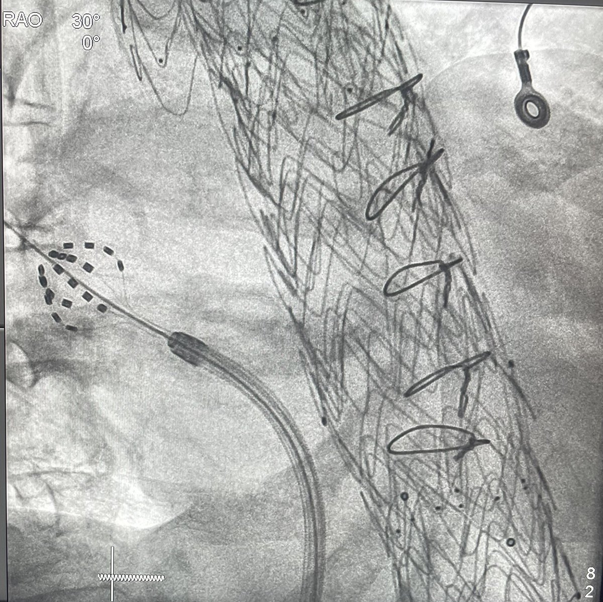 Christian-H. Heeger (@christianheeger) on Twitter photo First #FaraFriday of 2025 at #EP_Altona! ⚡️
Let’s share our experiences with challenging #Farapulse cases!
✅We start with this extraordinary case PVI in a patient with aortic arc reconstruction!
#full_metal_jacket_alike 😳
<a href="/RolandTilz/">Roland Tilz</a> <a href="/jongichun/">Julian Chun</a> <a href="/Phiso_de/">Philipp Sommer</a> <a href="/ShaojieChen1/">Shaojie Chen</a> First #FaraFriday of 2025 at #EP_Altona! ⚡️
Let’s share our experiences with challenging #Farapulse cases!
✅We start with this extraordinary case PVI in a patient with aortic arc reconstruction!
#full_metal_jacket_alike 😳
<a href="/RolandTilz/">Roland Tilz</a> <a href="/jongichun/">Julian Chun</a> <a href="/Phiso_de/">Philipp Sommer</a> <a href="/ShaojieChen1/">Shaojie Chen</a>
