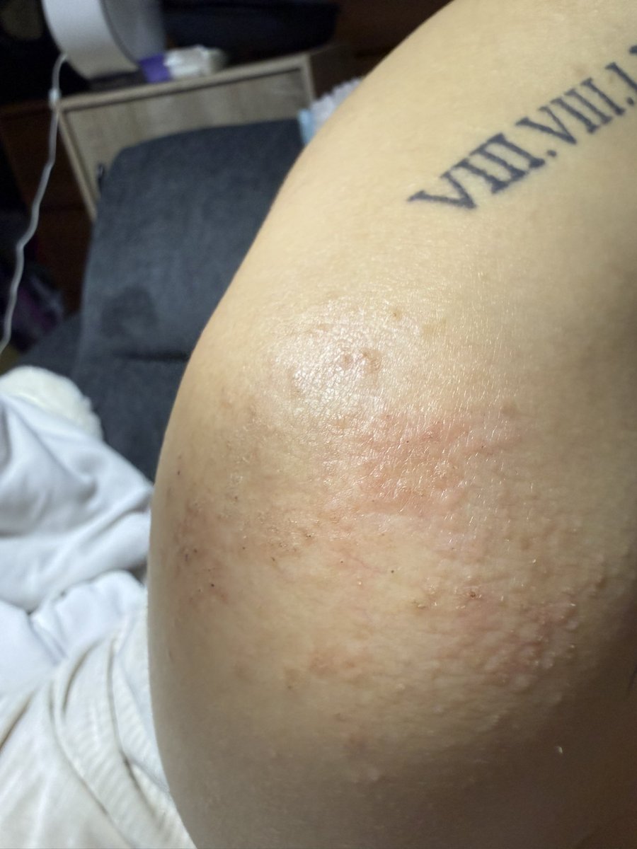 有人知道這是什麼皮膚病嗎
假日診所沒開打算禮拜一就去看🥹 https://t.co/LyZwwmwjJT