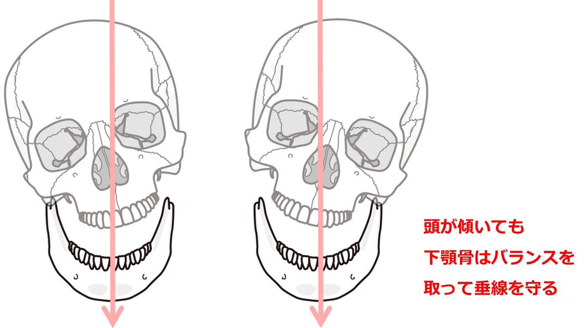 funain271's tweet image. 「顎関節症」はアゴのズレだけが原因ではなく、首の骨の歪みから起こる頭部の傾きが原因のことがあります。この場合、マウスピースや開口訓練やマッサージでは解決出来ません…。

funa-in.com/%e7%89%87%e5%9…

#顎関節症
#顎が痛い
#顔の歪み
#顎のズレ