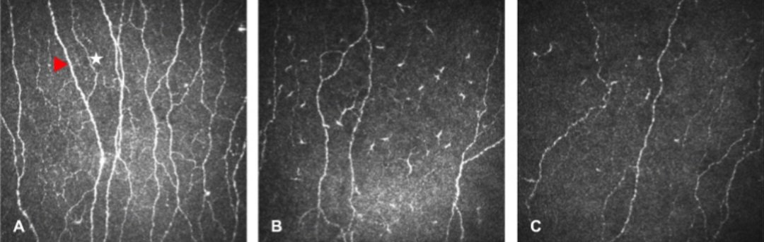 ENA Group 👁️ (@groupena) on Twitter photo As AI advances in the analysis of corneal nerve morphology, <a href="/Yiannaras/">Ioannis N. Petropoulos</a> et al., from Prof. <a href="/Rayazamalik/">Rayaz Malik</a>'s lab, showed that corneal confocal microscopy (CCM) can distinguish patterns of neurodegeneration in multiple sclerosis and epilepsy. Read more: pubmed.ncbi.nlm.nih.gov/39671224/ As AI advances in the analysis of corneal nerve morphology, <a href="/Yiannaras/">Ioannis N. Petropoulos</a> et al., from Prof. <a href="/Rayazamalik/">Rayaz Malik</a>'s lab, showed that corneal confocal microscopy (CCM) can distinguish patterns of neurodegeneration in multiple sclerosis and epilepsy. Read more: pubmed.ncbi.nlm.nih.gov/39671224/