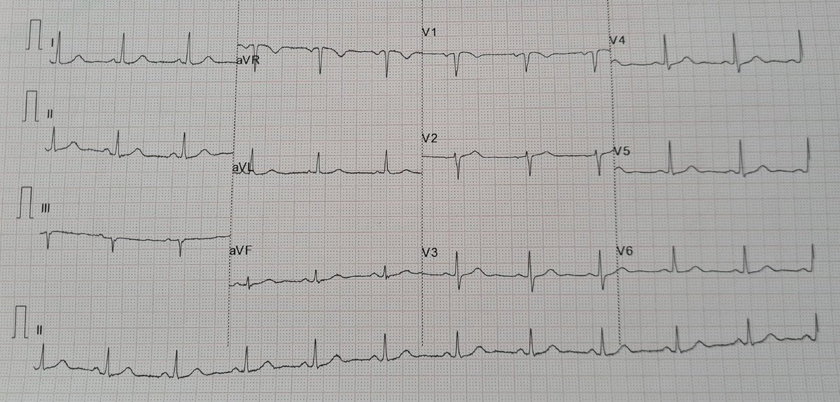 CardioAPFerrol's tweet photo. Para empezar el año 🎉 vamos a repasar las características de un ECG normal. 

Para su correcta lectura e interpretación debemos seguir unos pasos: ✍️

1⃣Comprobar siempre la calibración: velocidad 25mm/seg y amplitud 10mm/mV
2⃣Valorar regularidad/irregularidad y frecuencia cardíaca (nº QRS en 30 seg x 6) 
3⃣Leer las ondas, segmentos e intervalos de manera sistemática
4⃣Cálculo del eje cardíaco 

Os dejamos por aquí un ECG normal que nos sirve de ejemplo de lo dicho y una tabla con las características básicas de las ondas, intervalos y segmentos.