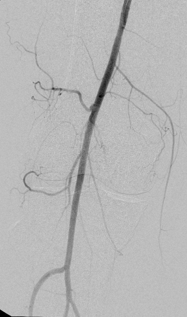 Osman Ahmed (@therealdoctoros) on Twitter photo Excited to announce our NIH-funded R21 study โSHAM-PAINโ ๐พ - A pilot double blind RCT sham study for GAE to treat symptomatic knee OA is officially IDE approved ๐๐ฝHoping to start enrolling by late Feb #irad ๐ฆด - Thank you to the whole team in getting this off the ground โค๏ธ Excited to announce our NIH-funded R21 study โSHAM-PAINโ ๐พ - A pilot double blind RCT sham study for GAE to treat symptomatic knee OA is officially IDE approved ๐๐ฝHoping to start enrolling by late Feb #irad ๐ฆด - Thank you to the whole team in getting this off the ground โค๏ธ