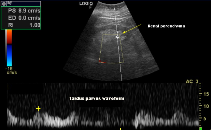 #POCUS for trainees
Another extremely high degree renal artery stenosis😱