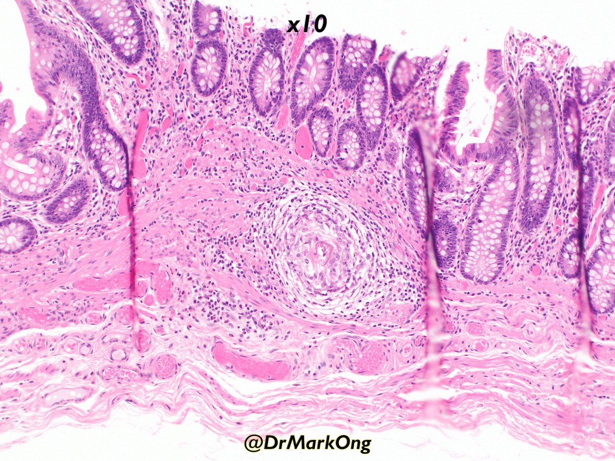 DrMarkOng's tweet image. Colectomy performed for cancer. Colleague&apos;s case.

Granulomata present away from cancer. On pictures 1 to 3, hard to be sure what they are, but picture 4 shows a viable schistosoma ovum.

GI schistosomiasis is usually S. mansoni or japonicum.

#GIpath #pathbugs