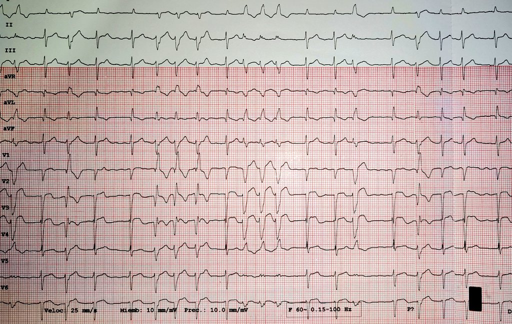 LopezLizarraga_'s tweet photo. 🫀🩺📜
Cual seria la mejor descripción para el siguiente electrocardiograma:
🚨¿Cuál es el Ritmo?
🚨¿Cambios en la morfología del QRS?
#ECG #EKG #Arritmia #Cardiologia #Cardiology @DrRajeshG1 @ecgandrhythmRoe @javier20ch @Perla_2298 @UlhasDr @Hapa_EP @EkgHacks
@cysu07 @javier20ch https://t.co/NM604FbgTp