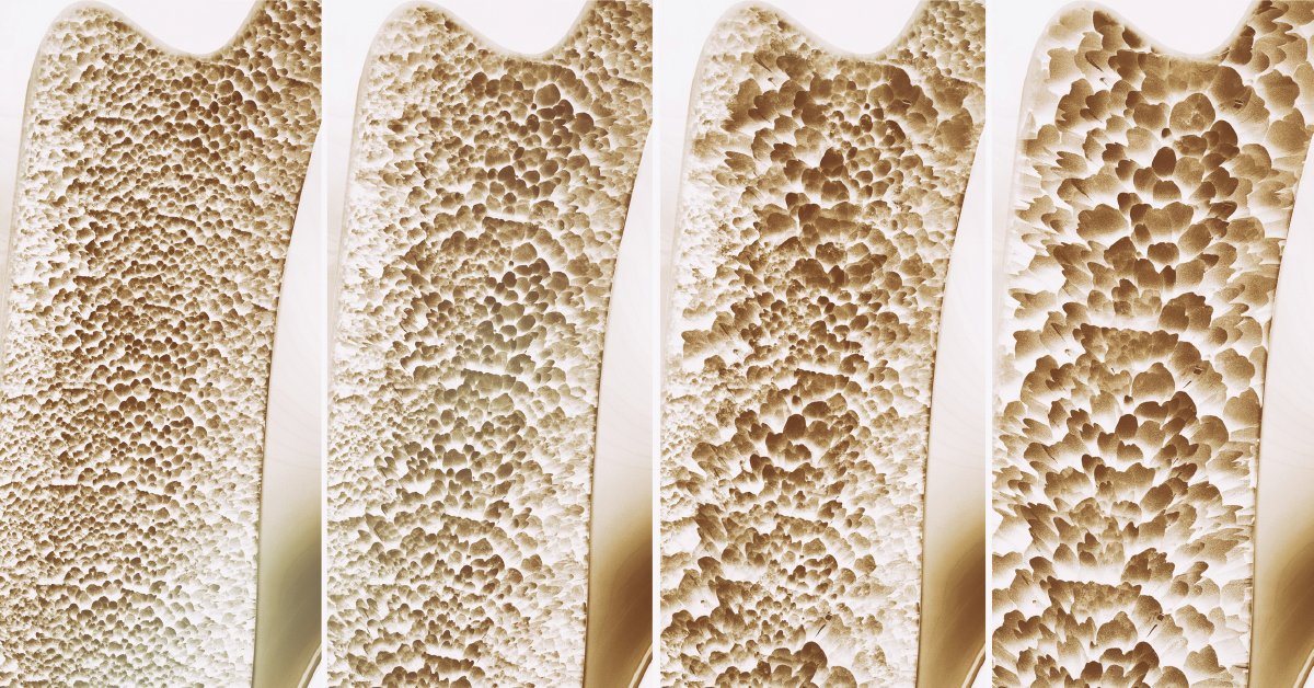 Without vitamin D, you can’t absorb the calcium from foods. That forces your body to raid your skeleton for the nutrient which weakens your bones. Good sources include: wb.md/4iJKKE9