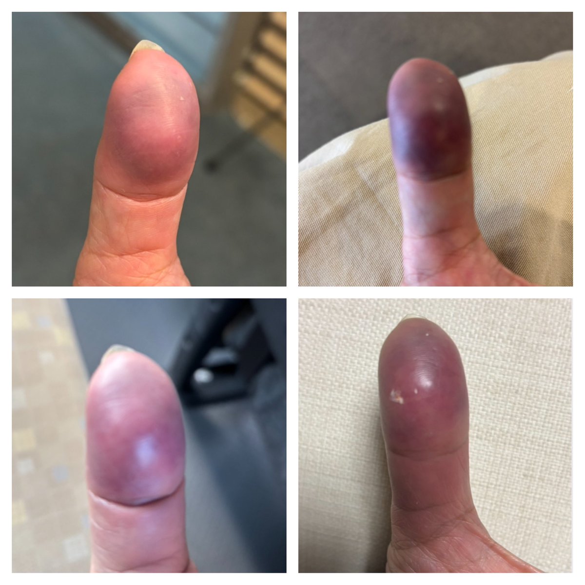 新年２日のラジオ正月特番前左親指車のドア挟み事件🤣
#骨折回避💦 #内出血 と芯の痛みは２週間位かかるそうですが、随分楽に😅
左上→放送直前
右上→5時間半のOA後急患へ
左下→ ３日熱もったのも痛みも落ち着き
右下→昨日は内出血が降りてきた？
私…運がいいかも✨

#正月爆笑ハプニング #痛い