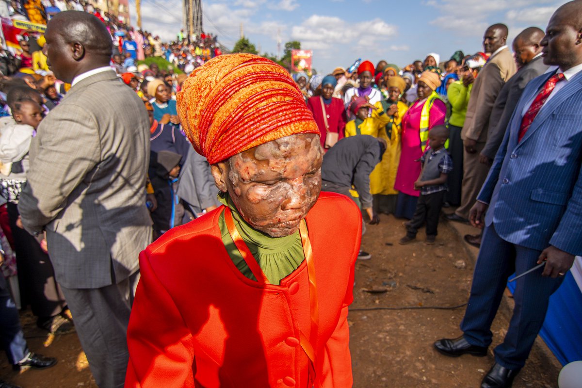 #CelebratingMenengai7 of WHAT JESUS HAS DONE!

💥Wounds dried up completely!💥
Ni YESU! Ni YESU! Ni YESU! Ni YESU!