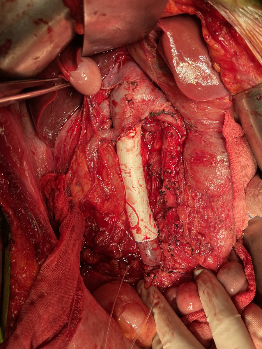 1st oncovas surgery in 2025, a huge retroperatoneal tumor with IVC involved. #oncovascular