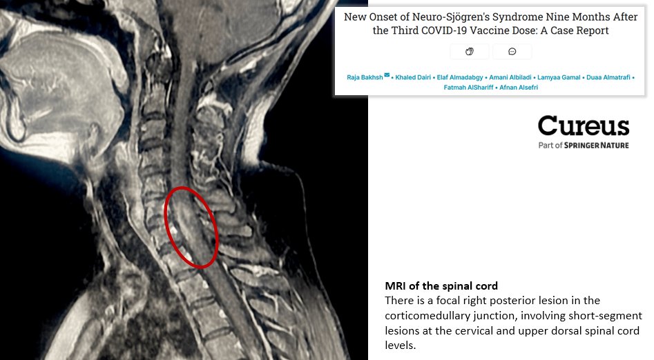 Neuro-Sjögren's syndrome (SS) in a 34-year-old woman 9 months after she received her third dose of COVID-19 vaccination -&gt; cureus.com/articles/28745…

SS: an autoimmune chronic inflammatory disease causing peripheral nerve system and central nervous system issues.

- "The present