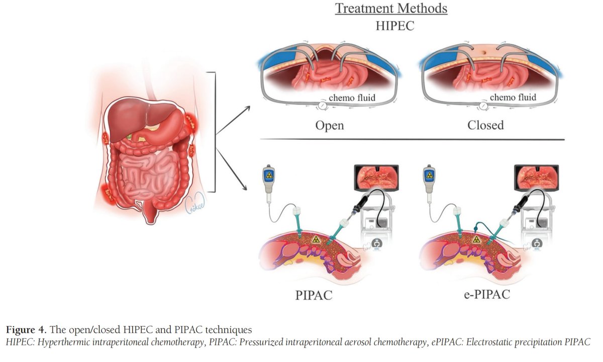 Aras Emre Canda (@arasemrecanda) on Twitter photo Experimental Modeling and Treatment Strategies for Peritoneal Carcinomatosis - Turkish Journal of Colorectal Disease turkishjcrd.com/articles/doi/t… @b0c0ce94-e611-46f7-a5ae-a55f60622a67 aracılığıyla <a href="/turkdiscolrect/">Turkish Journal of Colorectal Disease</a> <a href="/SeverTolga/">Tolga Sever</a> <a href="/tkrcd/">たく</a>
Special thanks to <a href="/gokcetaniyan/">Gökçe Tanıyan</a> for original Experimental Modeling and Treatment Strategies for Peritoneal Carcinomatosis - Turkish Journal of Colorectal Disease turkishjcrd.com/articles/doi/t… @b0c0ce94-e611-46f7-a5ae-a55f60622a67 aracılığıyla <a href="/turkdiscolrect/">Turkish Journal of Colorectal Disease</a> <a href="/SeverTolga/">Tolga Sever</a> <a href="/tkrcd/">たく</a>
Special thanks to <a href="/gokcetaniyan/">Gökçe Tanıyan</a> for original