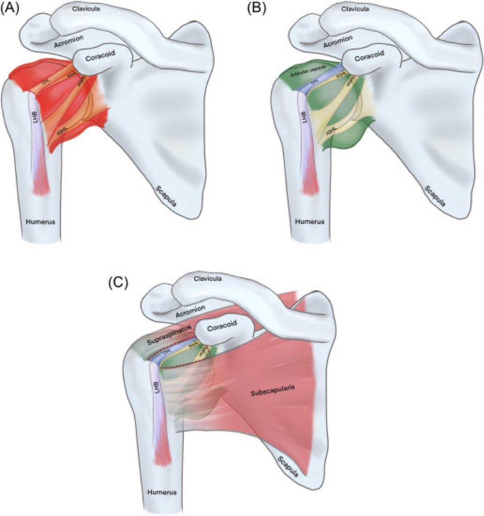 The pathophysiology of frozen shoulder

A) frozen shoulder with thickened &amp; contracted glenohumeral capsule/⤵️volume of axillary poach
B) articular space &amp; ligaments 
C) shoulder joint with rotator cuff muscles, rotator cuff interval, long head of biceps

sciencedirect.com/science/articl…