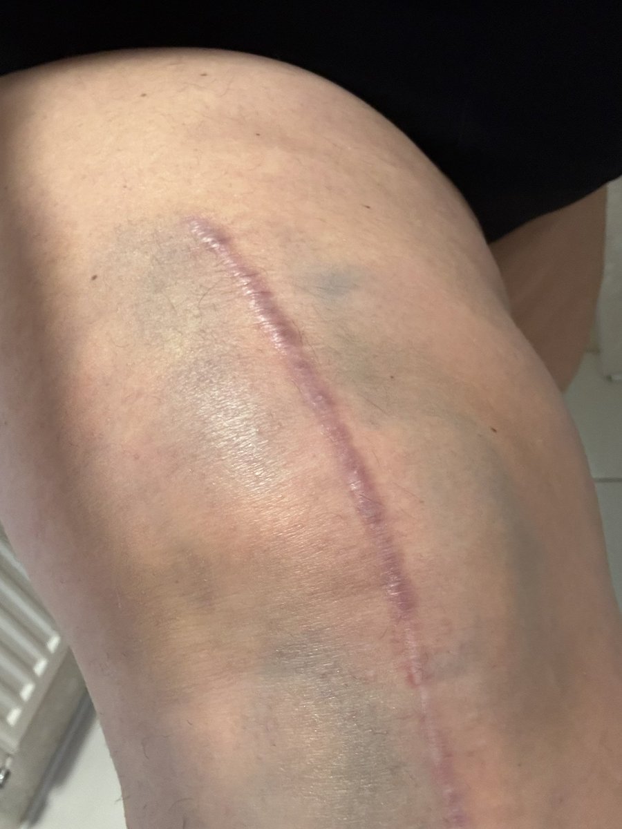 hannantamanda's tweet photo. 😳 😳 😳 😳

At physio yesterday I tripped on the stair and fell on my knee 😖. Felt embarrassed and sick 🤢. Very swollen and bruised, but do seem to have more movement today 😬. Most people have a Manipulation Under Anaesthetic, but I may have done mine without 😵‍💫 https://t.co/pAvzMs5ueB