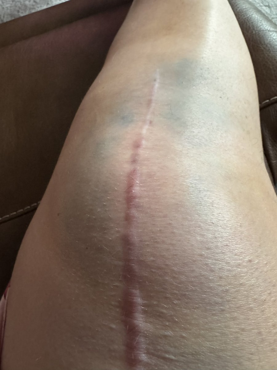 hannantamanda's tweet photo. 😳 😳 😳 😳

At physio yesterday I tripped on the stair and fell on my knee 😖. Felt embarrassed and sick 🤢. Very swollen and bruised, but do seem to have more movement today 😬. Most people have a Manipulation Under Anaesthetic, but I may have done mine without 😵‍💫 https://t.co/pAvzMs5ueB