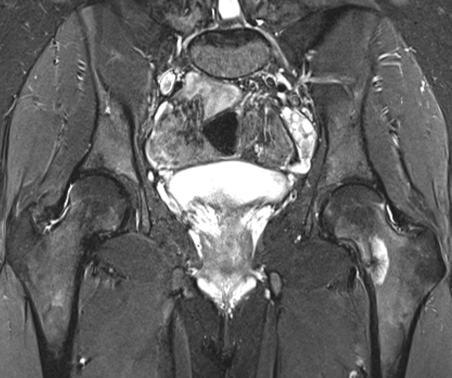 mskteachingroom's tweet image. Severe left hip pain in a 20 year old female. How would you report this case?

link to case 👇
pacsbin.com/c/W1Saqavz6q

#radiology #radiologist #mskrad #radres #orthoresident #radtwitter #medstudent #MedTwitter #orthotwitter #radtwitter #BONE 

@SidThakerMSK @jacja_