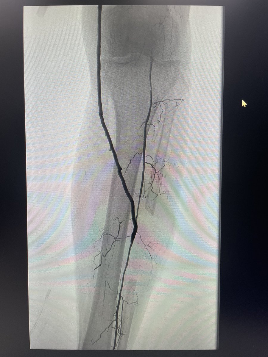 yuejianing's tweet photo. A CERAB at aortoiliac and in-situ distal bypass to PerA. #CLTIFighter #limbsalvage https://t.co/4L6mTFmBI6
