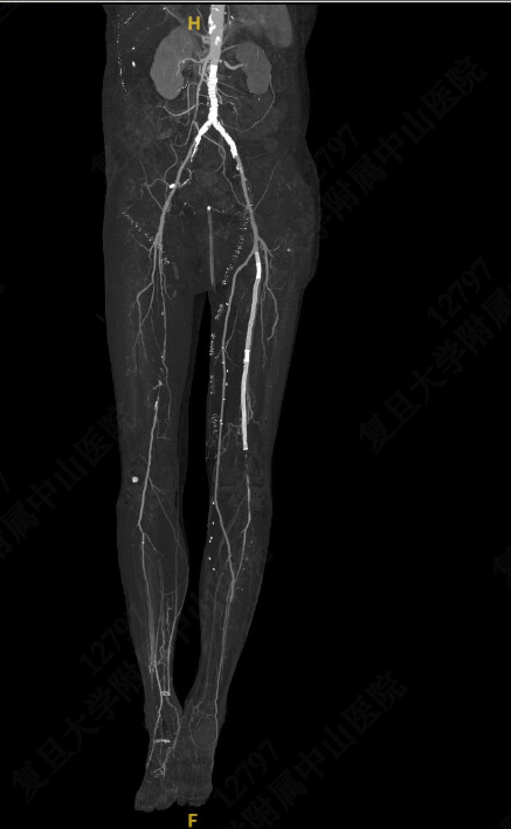 yuejianing's tweet photo. A CERAB at aortoiliac and in-situ distal bypass to PerA. #CLTIFighter #limbsalvage https://t.co/4L6mTFmBI6