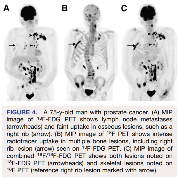 PuriTanuj's tweet photo. Cocktail [18F]NaF and [18F]FDG PET-CT Scan for Evaluation of Malignancy #18FNaF #nucmed #molrad #nuclearmedicine #nuclearradiology #molecularimaging #petct #petmri #precisionmedicine #precisionimaging doi: 10.2967/jnumed.108.058339 https://t.co/9dEybOM7Ky