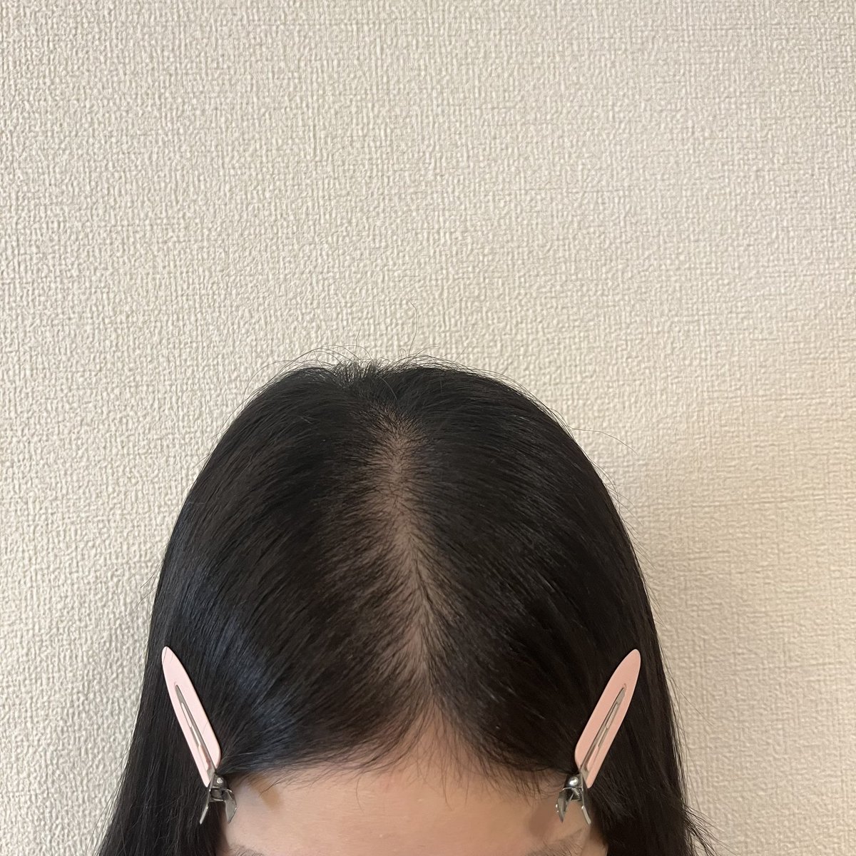 ppppp_8416's tweet photo. 【術後12ヶ月】①術前②術後8-9ヶ月③10ヶ月④12ヶ月 1年経過してひと段落😮‍💨😮‍💨大きな変化は感じられず、、むしろ内服やめた影響か前髪作ろうとしたときに量が減ってる気がする！抜け毛は少ないのになぜ、、#moandline #모앤드라인 ＃毛髪移植 #ヘアライン矯正 #ヘアライン植毛  #自毛移植 #自毛植毛 https://t.co/7UVwWPAt9U