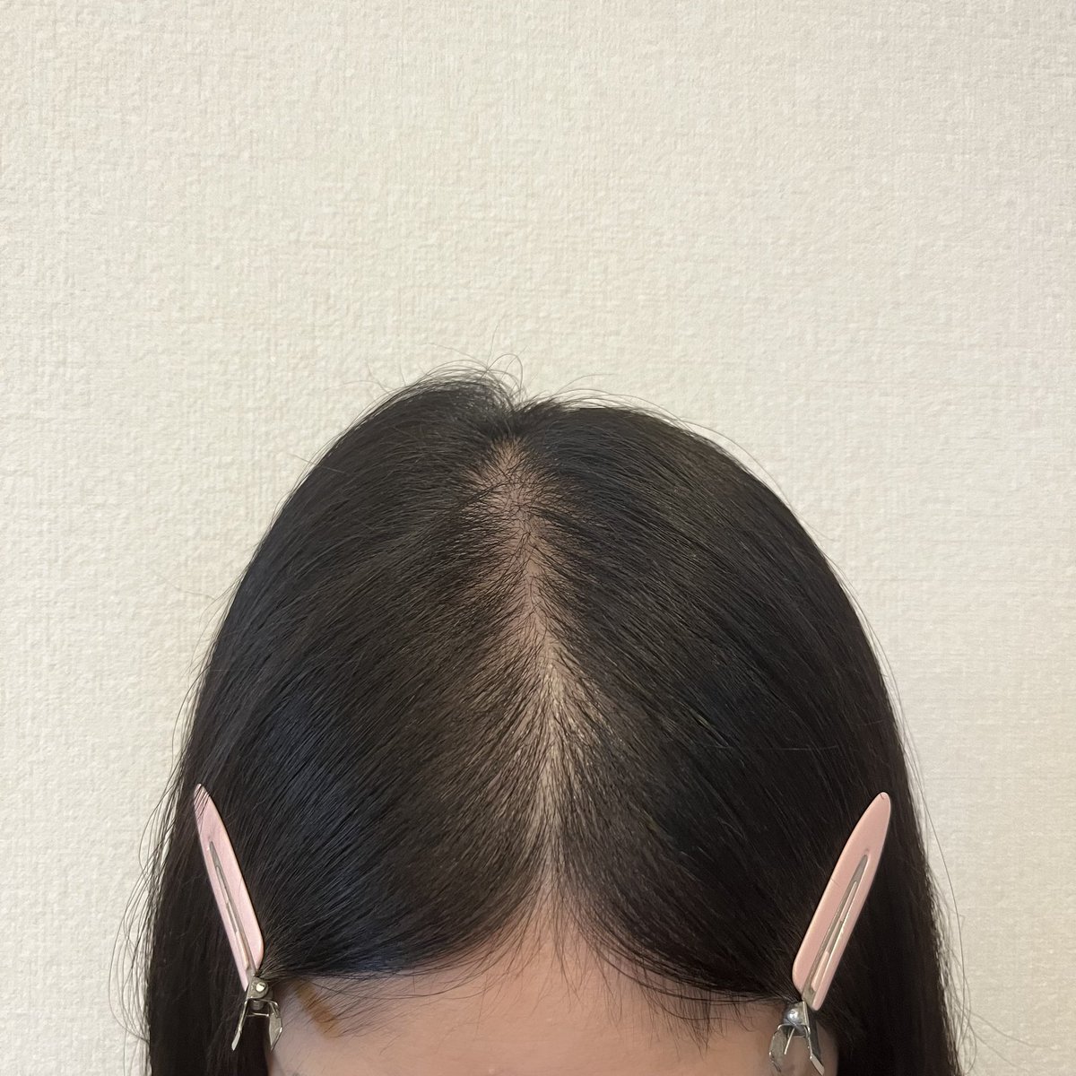 ppppp_8416's tweet photo. 【術後12ヶ月】①術前②術後8-9ヶ月③10ヶ月④12ヶ月 1年経過してひと段落😮‍💨😮‍💨大きな変化は感じられず、、むしろ内服やめた影響か前髪作ろうとしたときに量が減ってる気がする！抜け毛は少ないのになぜ、、#moandline #모앤드라인 ＃毛髪移植 #ヘアライン矯正 #ヘアライン植毛  #自毛移植 #自毛植毛 https://t.co/7UVwWPAt9U