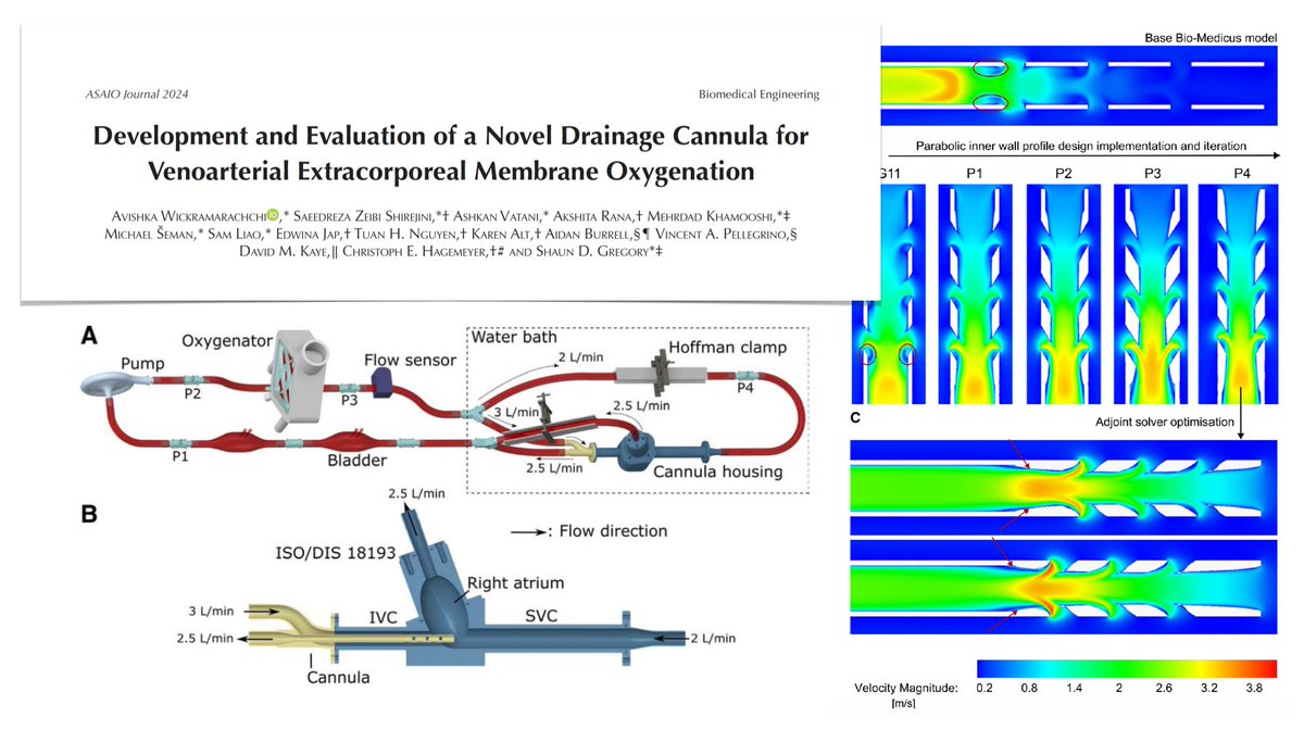 M Velia Antonini (@foamecmo) on Twitter photo Development of novel VA #ECMO drainage cannula
⚙️ fluid dynamics #simulation
🔍 ex vivo evaluation
🩸hemolysis assay
🩸PLT activation & receptor shedding
🩸degradation of vW factor multimers
🩸clot volume analysis within cannulae
<a href="/asaiojournal/">asaiojournal</a>
🔗 bit.ly/4a4zpKJ Development of novel VA #ECMO drainage cannula
⚙️ fluid dynamics #simulation
🔍 ex vivo evaluation
🩸hemolysis assay
🩸PLT activation & receptor shedding
🩸degradation of vW factor multimers
🩸clot volume analysis within cannulae
<a href="/asaiojournal/">asaiojournal</a>
🔗 bit.ly/4a4zpKJ