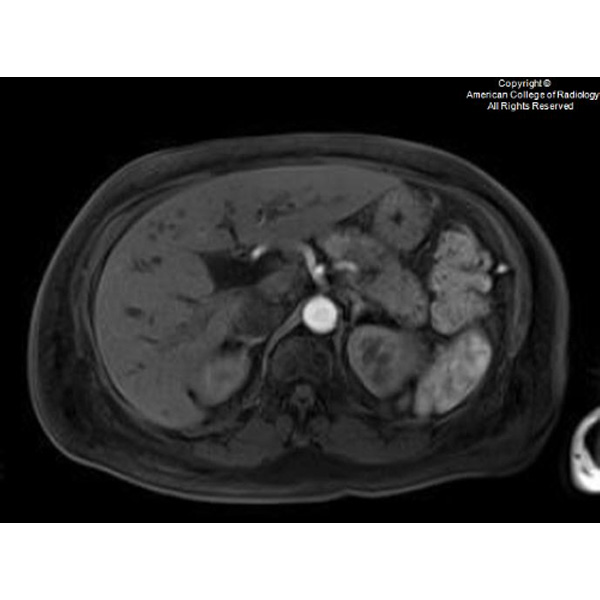 A 63-year-old woman presents with a pancreatic head mass. She has a medical history of hypertension/hyperlipidemia, type 2 diabetes mellitus…#ACRCaseinPoint bit.ly/4gnbUPm