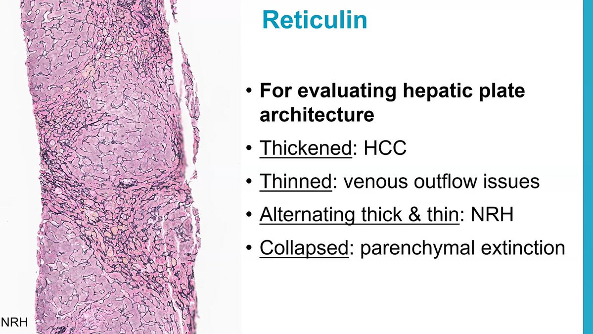#JobPrepBootcamp
Liver- Reticulin stains
For evaluation of hepatic plate architecture: Normal is 2-3 cells thick
-Thickened: Hepatocellular carcinoma
-Thinned: venous outflow issues
-Alternating thick and thin: Nodular regenerative hyperplasia (see pic)
-Collapsed: parenchymal