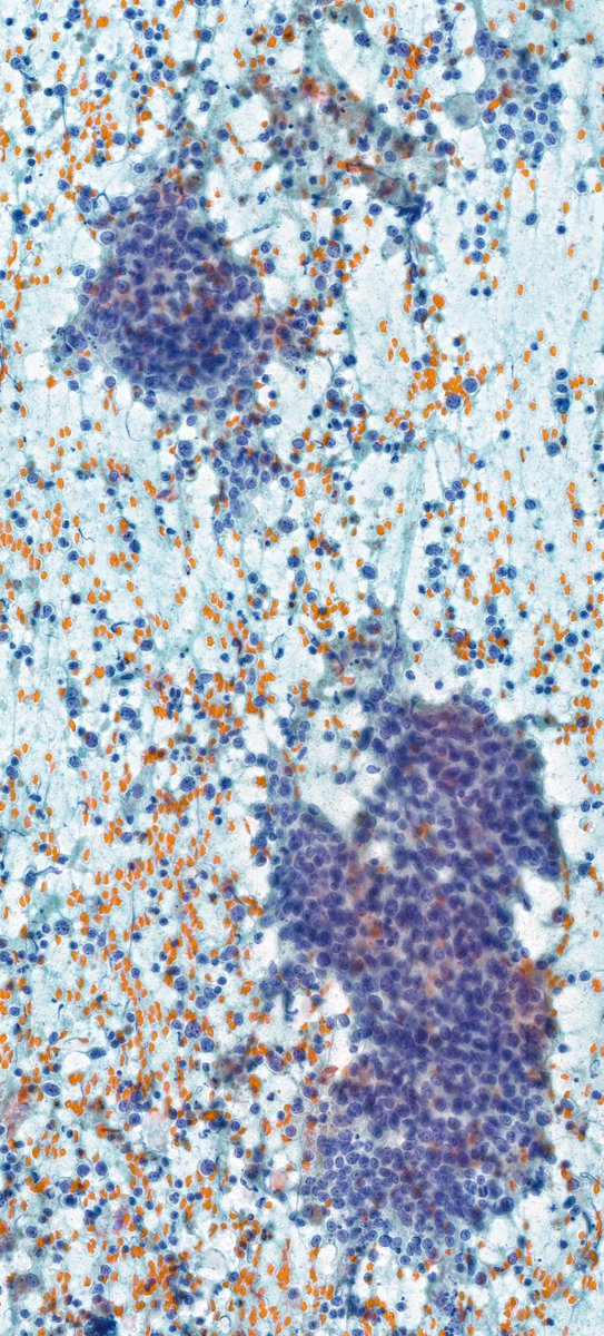 FNA of a parotid mass. 
What is your interpretation?
A) Non-diagnostic
B) Non-neoplastic
C) Benign neoplasm
D) Suspicious for malignancy
#Pathology #CytoPath #CytoPathology #PathTwitter 
🔬learn.mghpathology.org/index.php/WSI2…