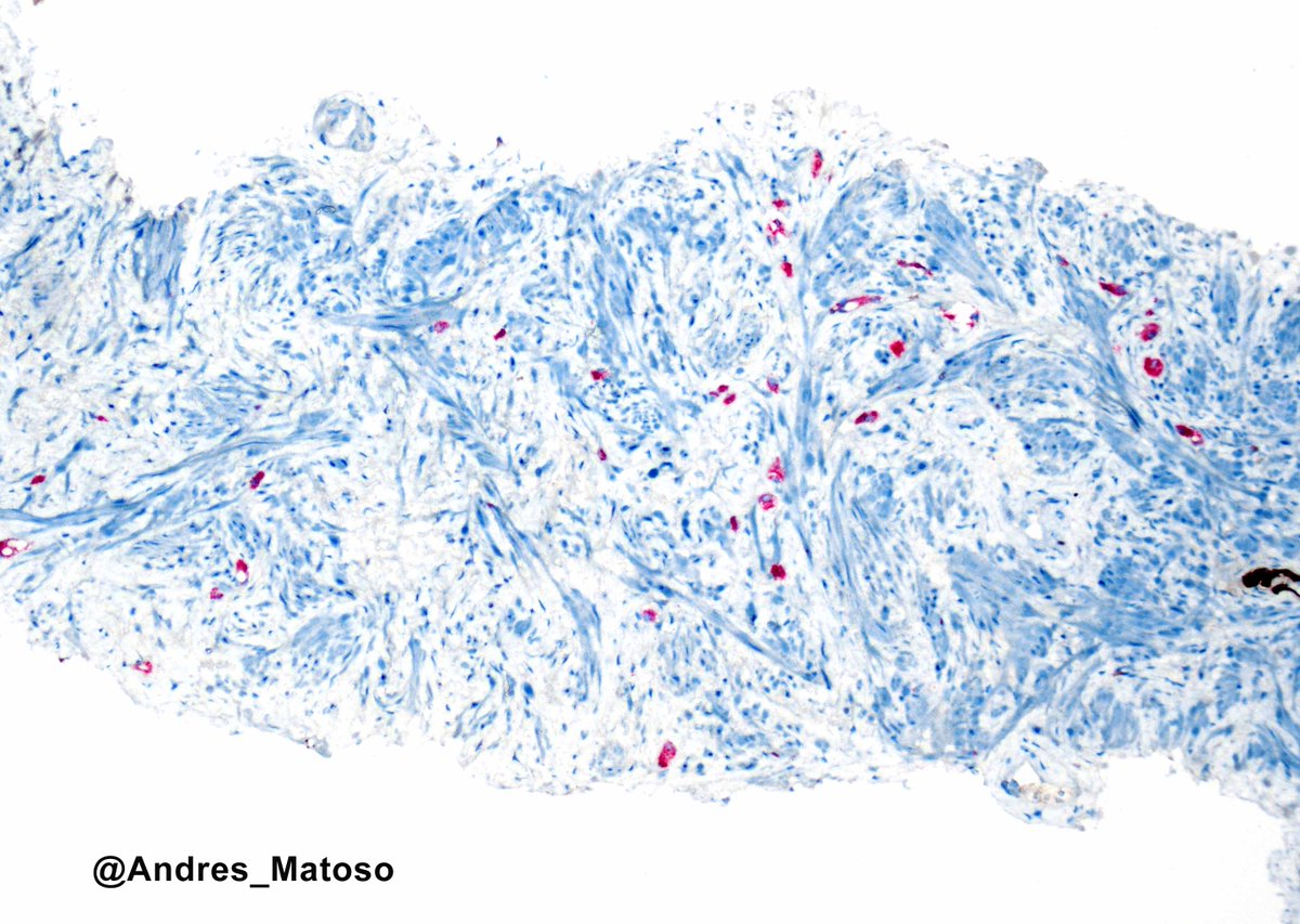 Prostate cancer with treatment effects following radiotherapy exhibits single cells with large, eccentric nuclei and abundant pale or foamy cytoplasm. Identification can be challenging at low magnification but is distinctly highlighted by PIN4 staining. Grading is not applicable
