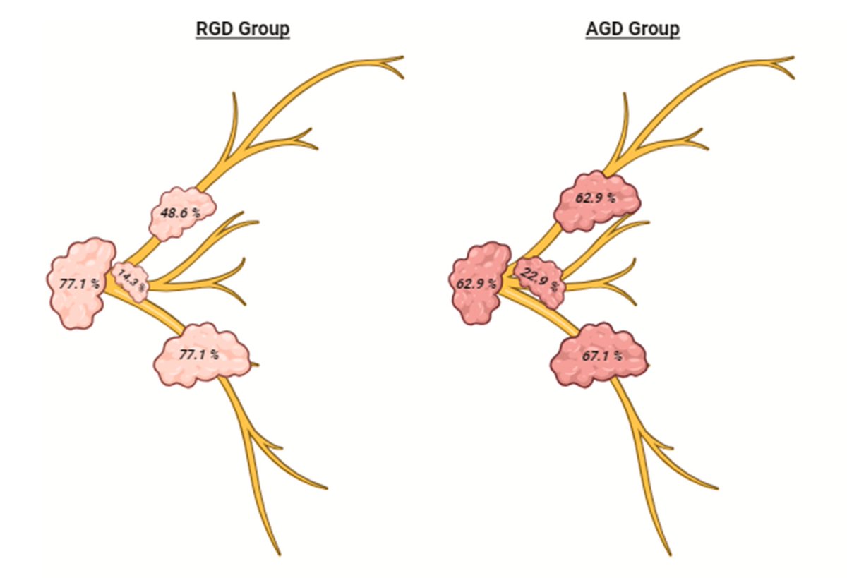 emerse (@projectemerse) on Twitter photo Researchers used EMERSE for a "retrospective analysis of all patients undergoing superficial parotidectomy for biopsy-confirmed benign parotid gland tumors over a five-year period." <a href="/Jossmi23/">Joshua Smith, MD</a> <a href="/MattSpector4/">Matthew E. Spector, MD, FACS</a> sciencedirect.com/science/articl… Researchers used EMERSE for a "retrospective analysis of all patients undergoing superficial parotidectomy for biopsy-confirmed benign parotid gland tumors over a five-year period." <a href="/Jossmi23/">Joshua Smith, MD</a> <a href="/MattSpector4/">Matthew E. Spector, MD, FACS</a> sciencedirect.com/science/articl…