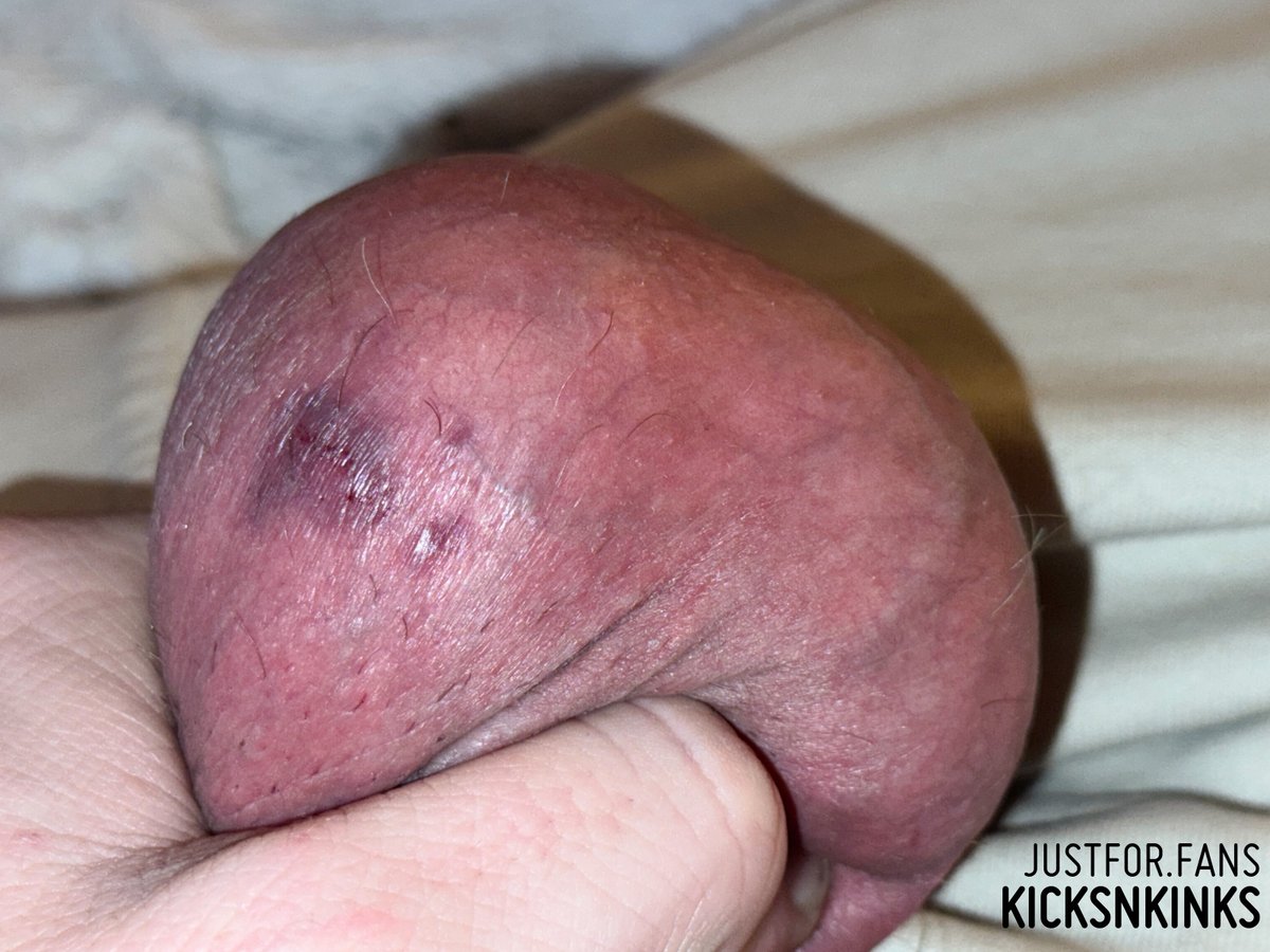 This is what an OWNED NUT SACK should look like, at all times.    Nelson just DESTROYED these balls, a few moments ago.... and he is coming back for MORE.  There is no pity for Owned Balls.  

See this and more at:
justfor.fans/kicksNkinks?So…