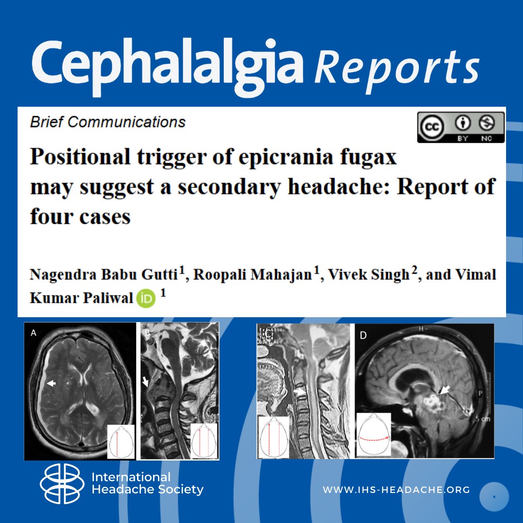 Epicrania fugax triggered by head/neck movement or change in position may be due to subdural hepatoma, posterior fossa lesions or cervical vertebral lesions.

journals.sagepub.com/doi/10.1177/25…
#headache #neurology #pain