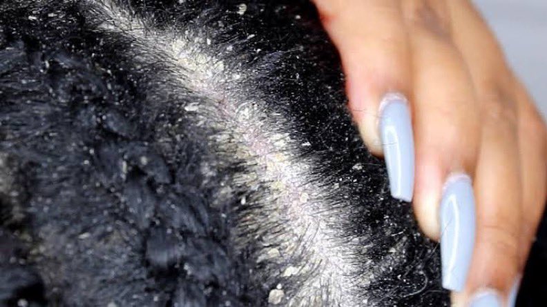 DANDRUFF : CAUSES AND REMEDIES 

Dandruff is such an embarrassing scalp condition.

Some women are  on lowcut today because of Dandruff

Some have tried all kinds of remedies, to no avail 

This thread exposes a lot you need to know 

Come with me 👇