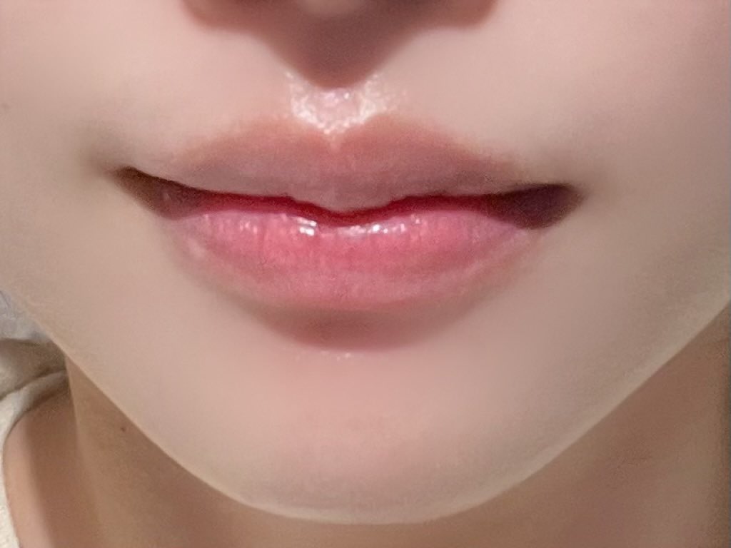 kimmari0721's tweet photo. これ見て人生初の唇フィラー受けてきた！🩷(after右側)
上下のボリュームちょうど良い感じに出たし、気になってた左右非対称も整えてくれて満足度高すぎる
私はM字すぎる形は似合わないから、山作りすぎないようにってお願いしたんだけど、たらこにならずに自然なぷるっと感で嬉しすぎ（ ;  ; ）
私はジュビダームにしたけど、韓国産フィラーなら入れ放題22万ウォンらしい！
まだメイクしてみてないから、リップメイク後の唇も楽しみ💓