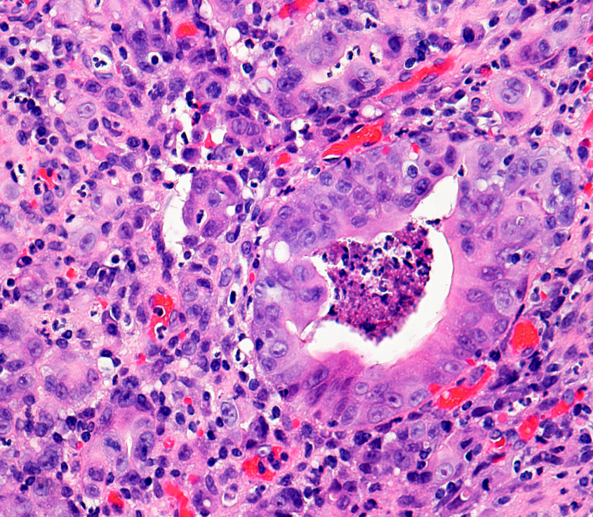 Stomach biopsy, what is your diagnosis?
#GIpath #PathX #PathTwitter