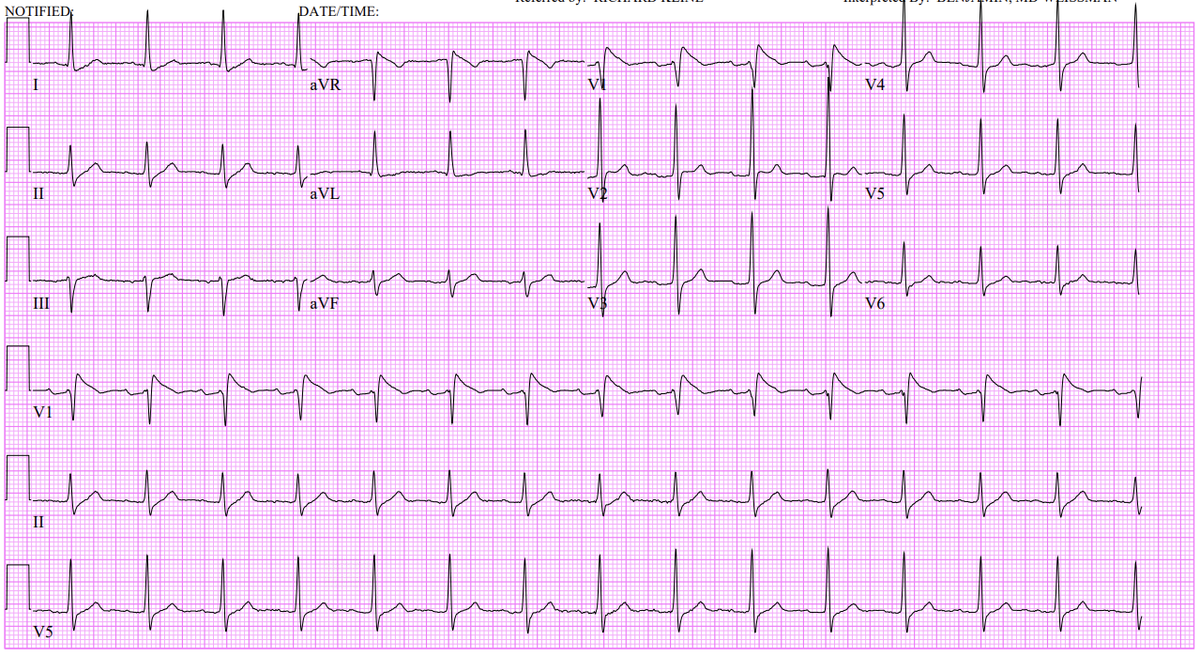 Pattara Rattanawong, MD, FACC, FHRS (@pat_nawong) on Twitter photo First AF and atypical AFL ablation in Brugada syndrome patient in the state of Hawaii !
<a href="/TFern5334/">Travis Fernandez</a> #EPeeps #Brugada First AF and atypical AFL ablation in Brugada syndrome patient in the state of Hawaii !
<a href="/TFern5334/">Travis Fernandez</a> #EPeeps #Brugada