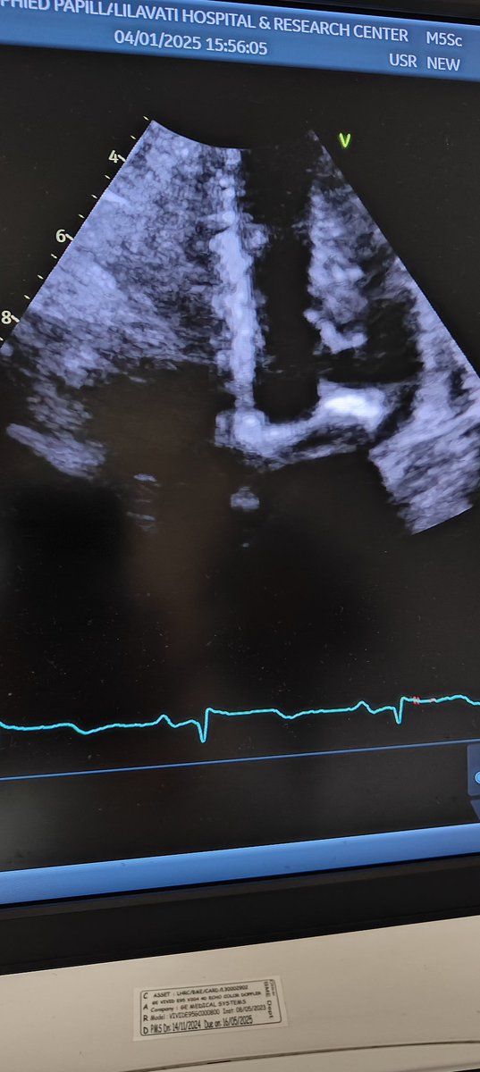 docsanz's tweet photo. F/76y Htn DM CRF
presented with ADHF
Echo LVEF 60% GLS-15% MR+ 
Conc LVH
Thick hypertrophied PM occupying LV cavity

Is this HCM variant https://t.co/XCydnPREVR