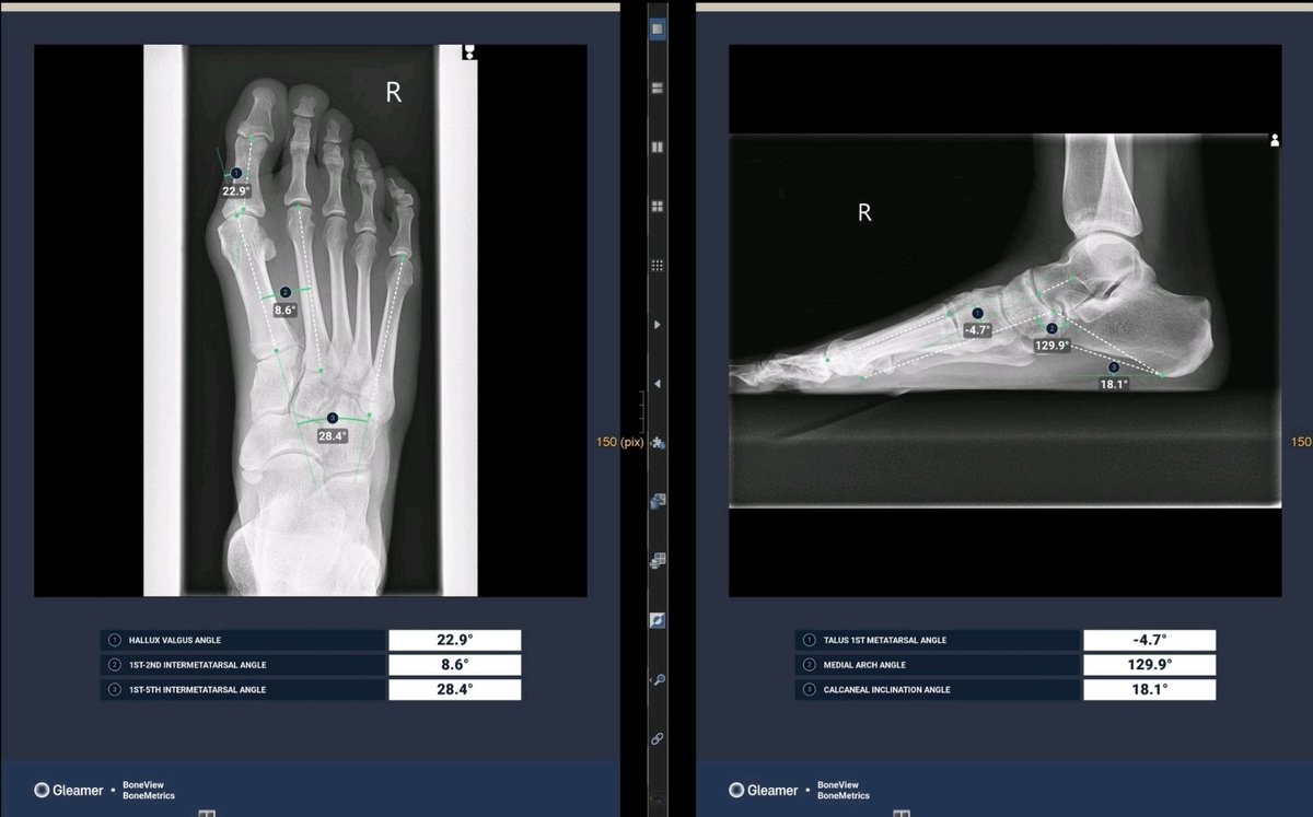 Perfektes Beispiel, warum ich bei KI-basierten Tools eine Plattformlösung bevorzuge. Mit deepc habe ich kürzlich eine Testphase für <a href="/gleamer_ai/">Gleamer</a> BoneView und BoneMetrics am Artemed Klinikum München Süd vereinbart. Es dauerte keine Woche, bis ich die Messungen im PACS sehen konnte.