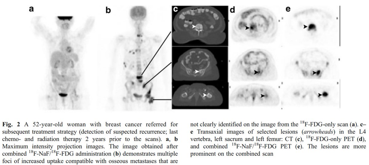 PuriTanuj's tweet photo. [18F]FDG+[18F]NaF PET-CT vs [18F]FDG PET-CT imaging for detection of malignancy #18FNaF #nucmed #molrad #nuclearmedicine #nuclearradiology #molecularimaging #petct #petmri #precisionmedicine #precisionimaging #CancerResearch  #BoneRemodeling   doi: 10.1007/s00259-011-1971-1 https://t.co/kGOwunTtl3