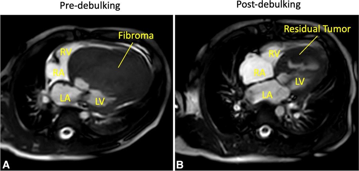 AATS (@aatshq) on Twitter photo New #congenital research: Surgical debulking of large ventricular fibromas in children. Researchers explore updates to the clinical presentation and operative strategies. Get access by logging in to #JTCVS: doi.org/10.1016/j.jtcv…
<a href="/JordanSecor/">Jordan Secor</a> <a href="/BostonChildrens/">Boston Children's</a> <a href="/harvardmed/">Harvard Medical School</a> New #congenital research: Surgical debulking of large ventricular fibromas in children. Researchers explore updates to the clinical presentation and operative strategies. Get access by logging in to #JTCVS: doi.org/10.1016/j.jtcv…
<a href="/JordanSecor/">Jordan Secor</a> <a href="/BostonChildrens/">Boston Children's</a> <a href="/harvardmed/">Harvard Medical School</a>