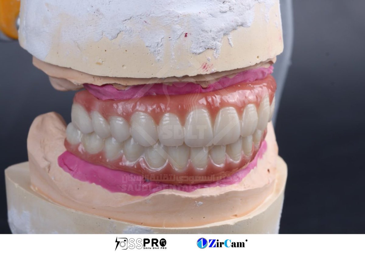 إعادة تأهيل شامل للفكين من خلال تصميم وصناعة أسنان ثابتة فوق الزرعات للفك العلوي والسفلي، لتحقيق ابتسامة طبيعية ووظائف مثالية. ✨
#Dentist #dental #معمل_اسنان